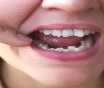       Croweded teeth