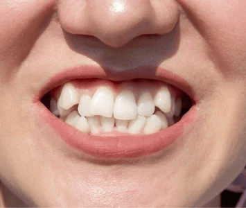  Poor Overlap of Teeth