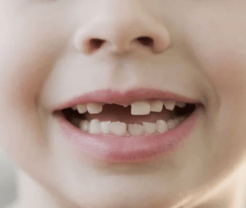   Extra or Missing Teeth