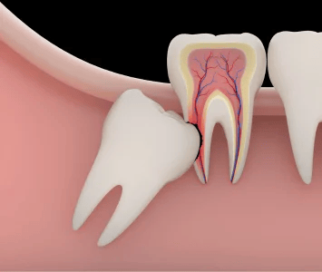       Impacted Teeth